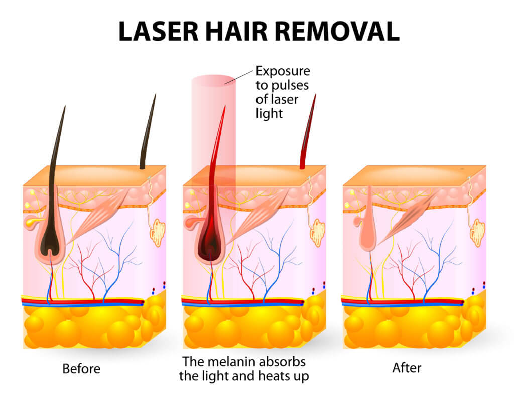 laser hair removal research