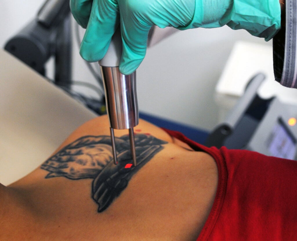 How Does Tattoo Removal Work? | POPSUGAR Beauty UK