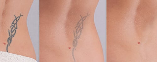 Fort Collins Laser Hair Tattoo Removal Fort Collins CO LaserAll