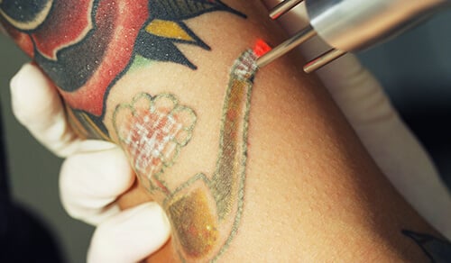 Tattoo Removal in Delhi: Cost, Procedure, and More | RasaDerm